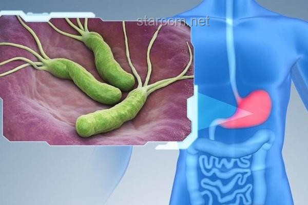 胃癌预防措施的深度对比与分析：饮食、体检、生活习惯与根除幽门螺杆菌