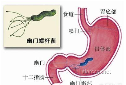 胃癌预防措施的深度对比与分析：饮食、体检、生活习惯与根除幽门螺杆菌